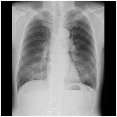 Spirometry test values can be estimated from a single chest radiograph